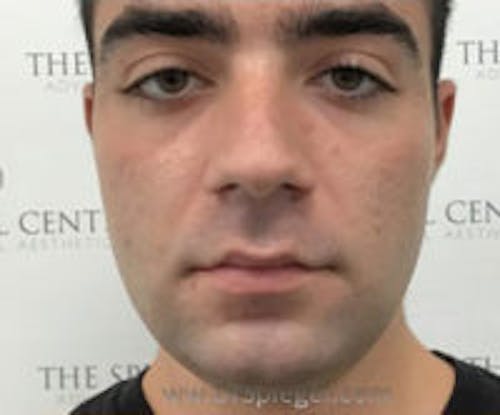Buccal Fat Reduction Before & After Gallery - Patient 773447 - Image 1