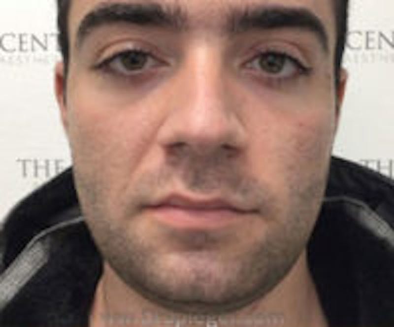 Buccal Fat Reduction Before & After Gallery - Patient 773447 - Image 2