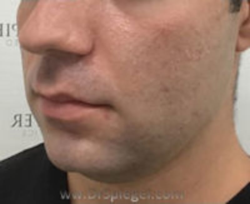 Buccal Fat Reduction Before & After Gallery - Patient 773447 - Image 3