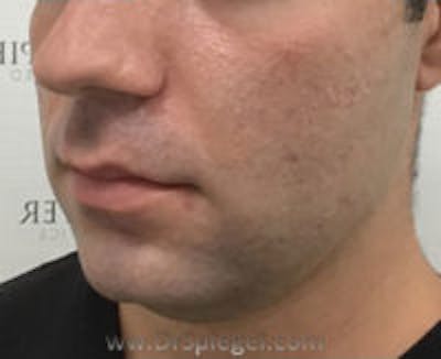 Buccal Fat Reduction Before & After Gallery - Patient 773447 - Image 3