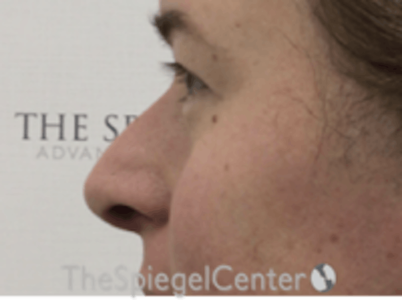 Cheek Implants Before & After Gallery - Patient 374010 - Image 1
