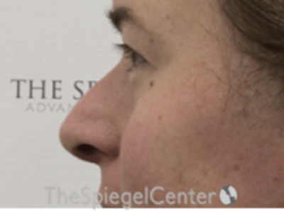 Cheek Implants Before & After Gallery - Patient 374010 - Image 1