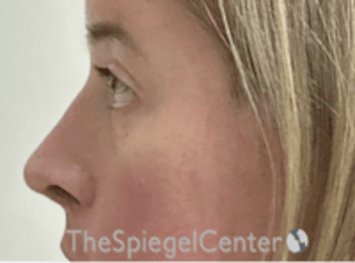 Cheek Implants Before & After Gallery - Patient 374010 - Image 2