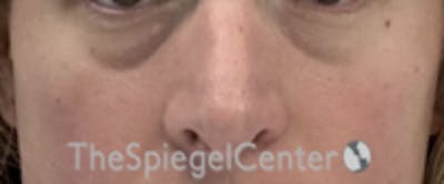 Cheek Implants Before & After Gallery - Patient 374010 - Image 3