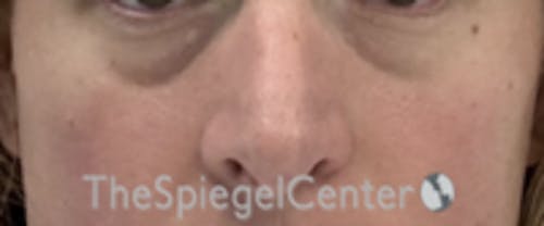 Cheek Implants Before & After Gallery - Patient 374010 - Image 3