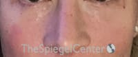 Cheek Implants Before & After Gallery - Patient 374010 - Image 4