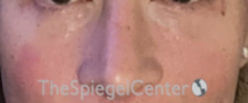 Cheek Implants Before & After Gallery - Patient 374010 - Image 4