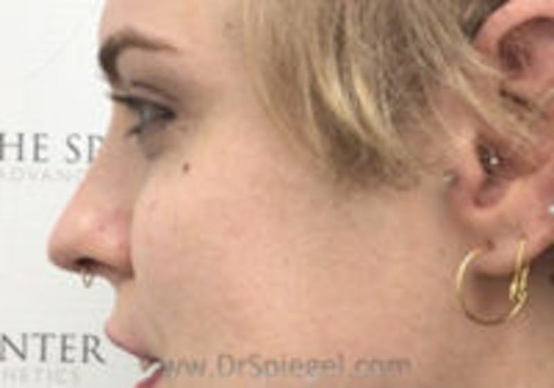 Cheek Implants Before & After Gallery - Patient 214451 - Image 1