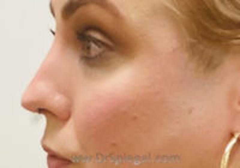 Cheek Implants Before & After Gallery - Patient 214451 - Image 2