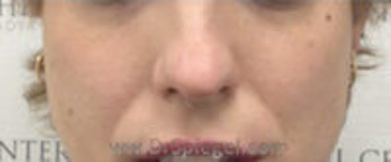 Cheek Implants Before & After Gallery - Patient 214451 - Image 3