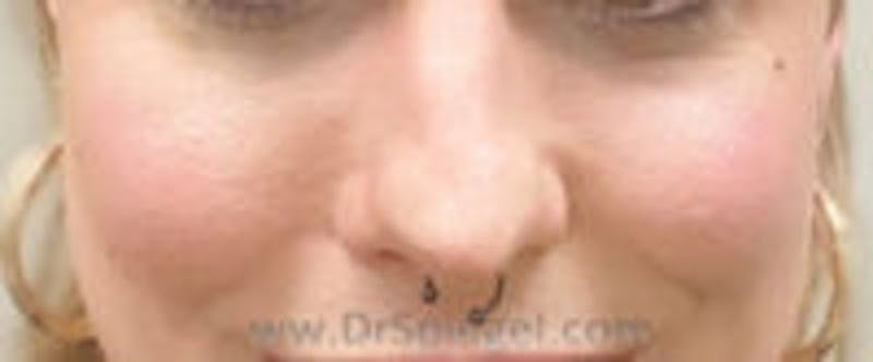 Cheek Implants Before & After Gallery - Patient 214451 - Image 4