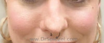Cheek Implants Before & After Gallery - Patient 214451 - Image 4