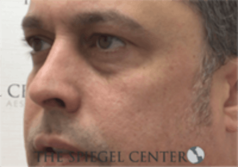 Cheek Implants Before & After Gallery - Patient 442417 - Image 1