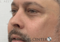 Cheek Implants Before & After Gallery - Patient 442417 - Image 2