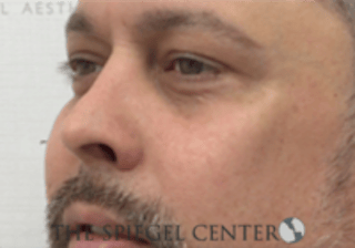 Cheek Implants Before & After Gallery - Patient 442417 - Image 2