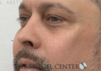 Cheek Implants Before & After Gallery - Patient 442417 - Image 2