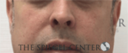 Cheek Implants Before & After Gallery - Patient 442417 - Image 3