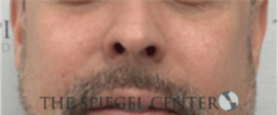 Cheek Implants Before & After Gallery - Patient 442417 - Image 4