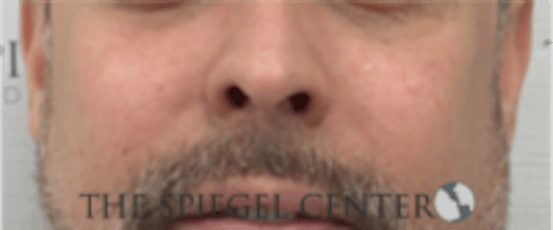 Cheek Implants Before & After Gallery - Patient 442417 - Image 4