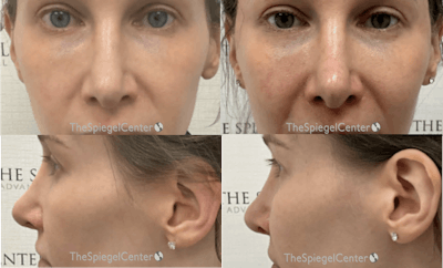 Cheek Implants Before & After Gallery - Patient 732403 - Image 1