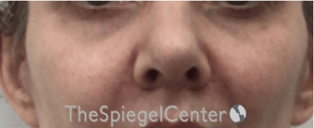Cheek Implants Before & After Gallery - Patient 971935 - Image 2