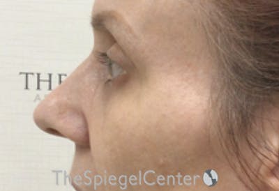 Cheek Implants Before & After Gallery - Patient 971935 - Image 3