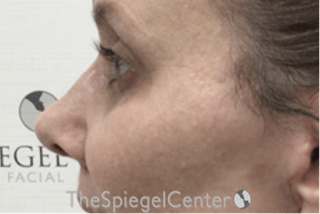 Cheek Implants Before & After Gallery - Patient 971935 - Image 4