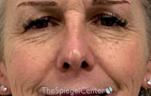 Cheek Implants Before & After Gallery - Patient 415787 - Image 1