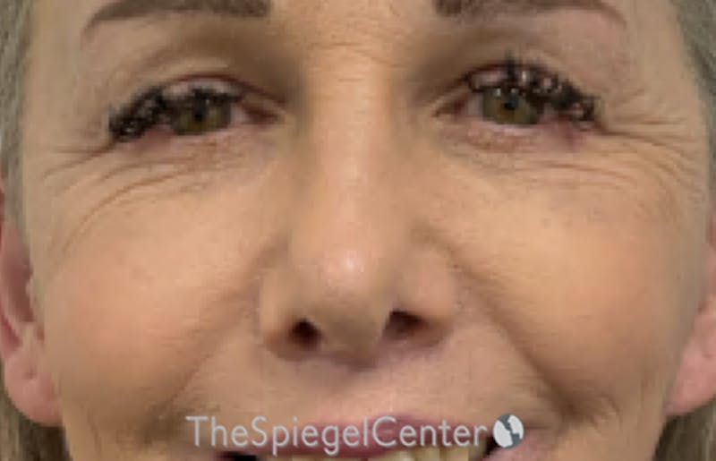 Rhinoplasty Before & After Gallery - Patient 181464 - Image 4