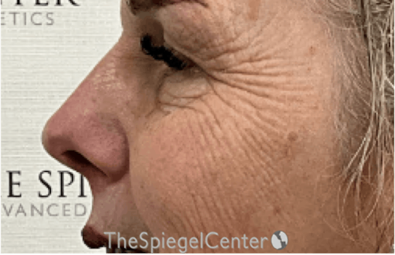 Rhinoplasty Before & After Gallery - Patient 181464 - Image 1