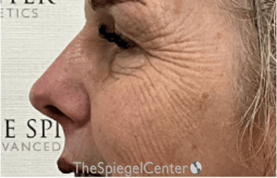 Cheek Implants Before & After Gallery - Patient 415787 - Image 3