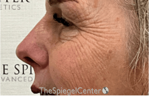 Cheek Implants Before & After Gallery - Patient 415787 - Image 3