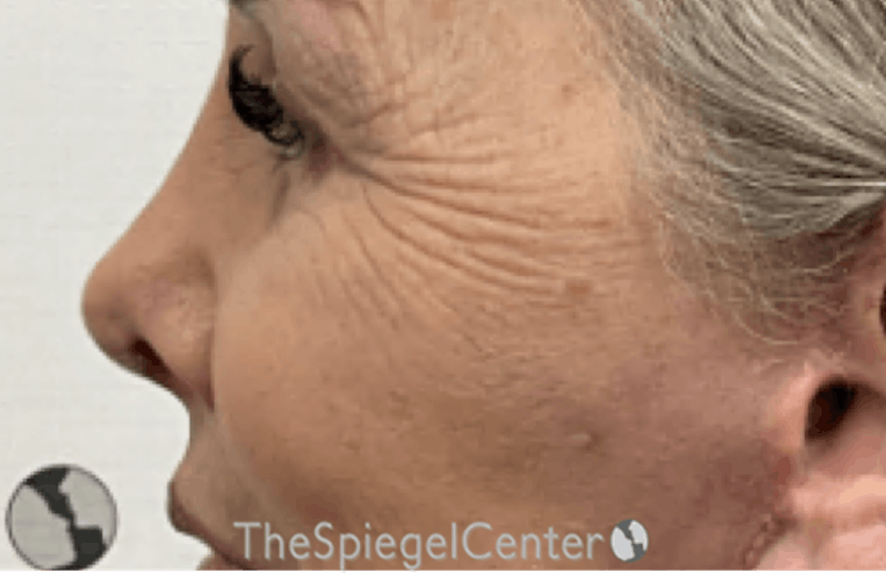 Rhinoplasty Before & After Gallery - Patient 181464 - Image 2