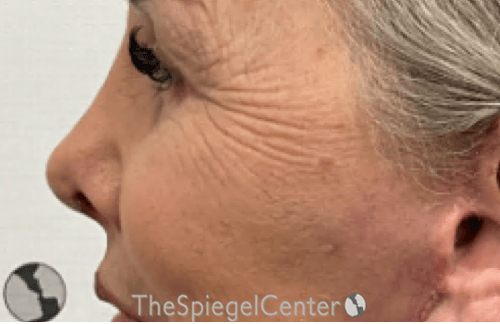 Cheek Implants Before & After Gallery - Patient 415787 - Image 4