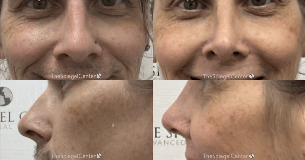 Cheek Implants Before & After Gallery - Patient 103371 - Image 1