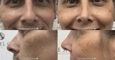 Cheek Implants Before & After Gallery - Patient 103371 - Image 1