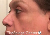 Cheek Implants Before & After Gallery - Patient 230315 - Image 1