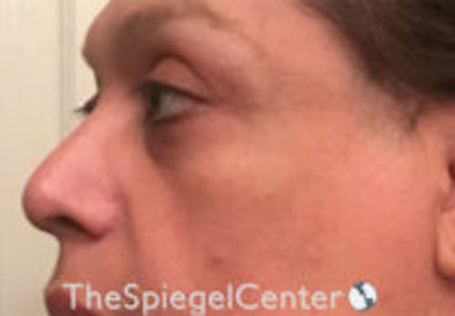 Cheek Implants Before & After Gallery - Patient 230315 - Image 1