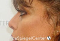 Cheek Implants Before & After Gallery - Patient 230315 - Image 2