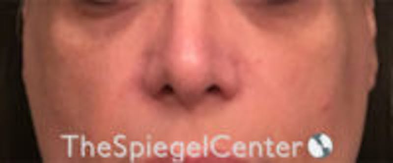 Cheek Implants Before & After Gallery - Patient 230315 - Image 3