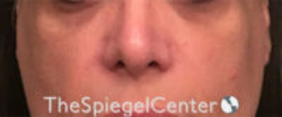 Cheek Implants Before & After Gallery - Patient 230315 - Image 3