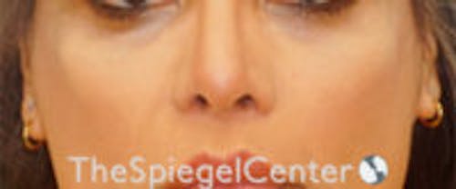 Cheek Implants Before & After Gallery - Patient 230315 - Image 4