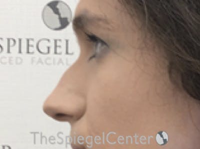 Cheek Implants Before & After Gallery - Patient 290261 - Image 1