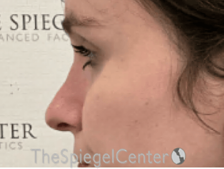 Cheek Implants Before & After Gallery - Patient 290261 - Image 2