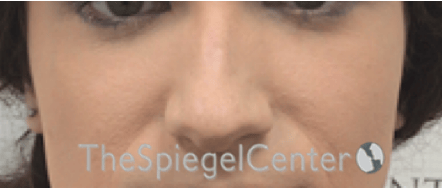 Cheek Implants Before & After Gallery - Patient 290261 - Image 3