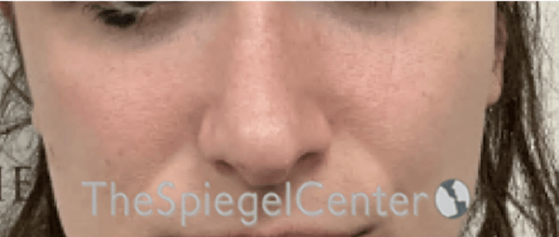 Cheek Implants Before & After Gallery - Patient 290261 - Image 4