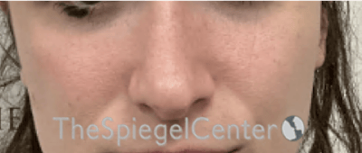 Cheek Implants Before & After Gallery - Patient 290261 - Image 4