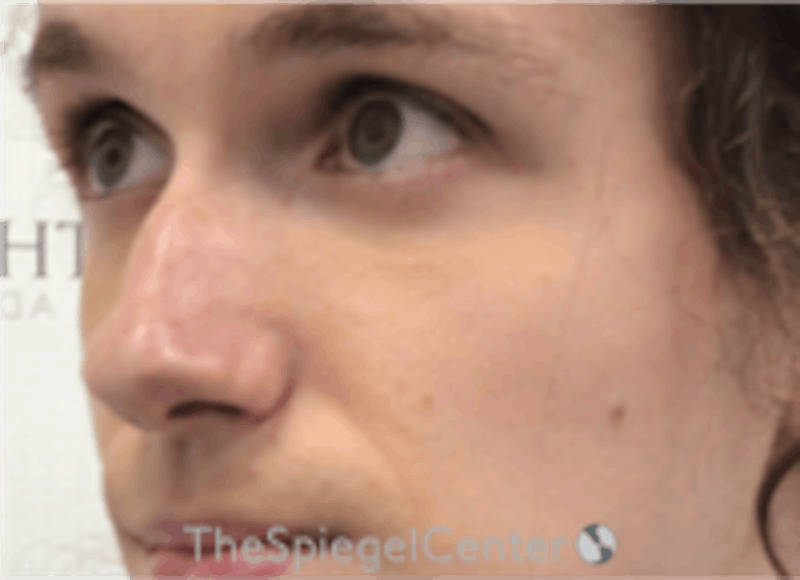 Cheek Implants Before & After Gallery - Patient 217656 - Image 1