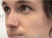 Cheek Implants Before & After Gallery - Patient 217656 - Image 1