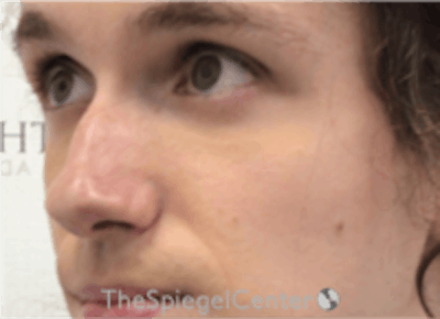 Cheek Implants Before & After Gallery - Patient 217656 - Image 1